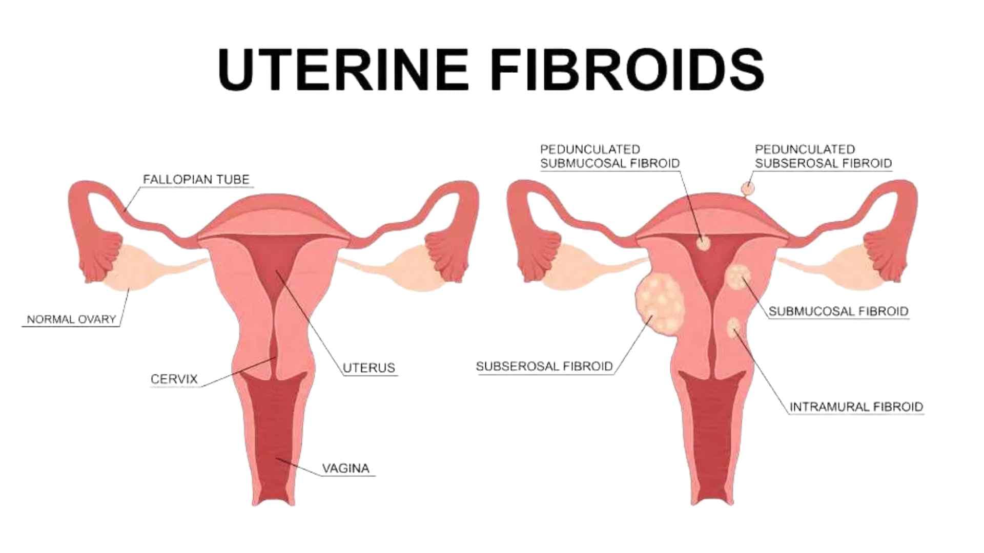 Fibroids During Pregnancy: Risks, Symptoms & Yoga Management - fibroids during pregnancy yoga management